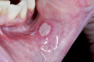 White spots and sores on gums: Causes, treatment, and symptoms