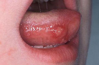 Ulcers on a child's tongue