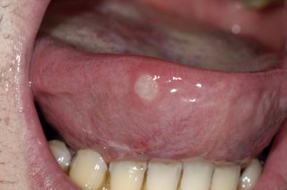 picture of mouth ulcer on tongue