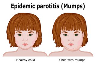 Two almost identical drawings of a child's face. One shows two sides of the child's face is normal and has no swelling. The other shows one side of the child's face and neck are swollen around the jaw.