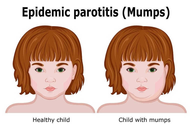Mumps symptoms HSE.ie