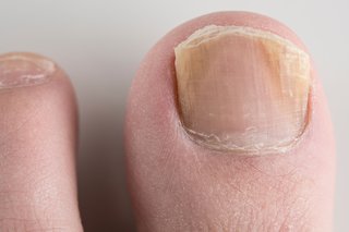 The nail on a person's big toe. The sides of the nail are yellow and the edge that's trimmed is flaky.