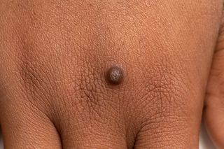 A round, raised dark wart shown on a hand with brown skin.