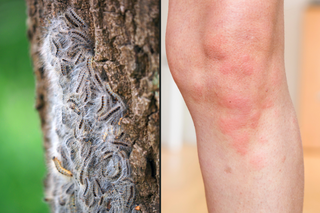 A side-by-side image of oak processionary moth caterpillars on an oak tree (left) and a rash on someone with white skin (right). There are raised bumps where the skin is reacting to the caterpillar hairs.
