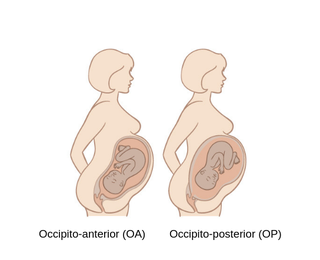 To the left is a baby in the womb with their head down facing inwards in the occipito-anterior position. To the right is a baby with their head down facing outwards in the Occipito-posterior position. (Edited)