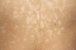 A close-up of pityriasis versicolor on white skin. There are several flat, pale patches covering the skin.