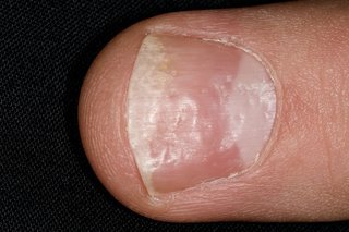 Finger with small dents in the finger nail