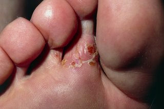 Athlete's foot on white skin. Close-up of the bottom of a foot with a red flaky patch behind 1 of the toes.