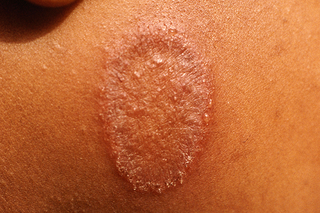 ringworm spreading on brown skin