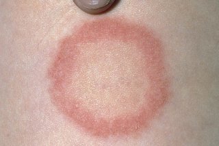 circular rash on white skin with red rim to circle and creamy skin inside the circle