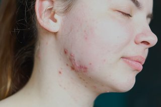 group of red spots on the jawline that has a rolling and uneven appearance, shown on white skin