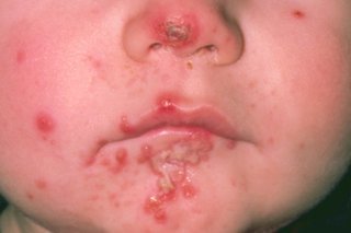 Lower face of a child with a red crusty sore on their nose and yellow-white blisters around their lips, shown on white skin.