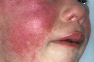 A red rash on a child's cheek