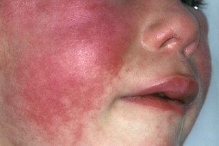 strep throat rash