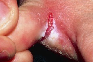 Athlete's foot on white skin. Toes are spread to show cracked skin that looks sore.