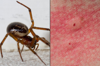 A side-by-side image of a false widow spider (left) and a spider bite shown on white skin (right). There is a red puncture mark and swelling on the skin.