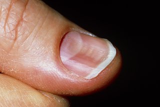 finger with finger nail that is curved inwards like a spoon