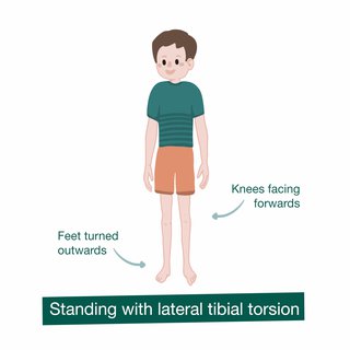 Illustration of out-toeing showing feet turned outwards