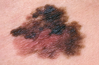 Brown mole on white skin with irregular edge and differences in colour