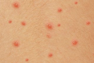 Chickenpox spots become blisters