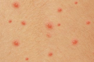 Chicken pox symptoms