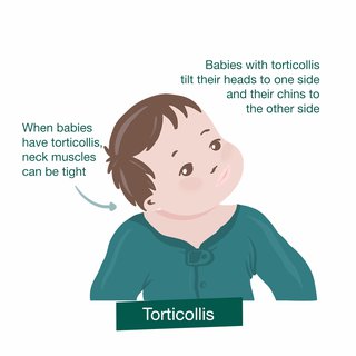 Illustration showing how babies with torticollis tilt their head and chin to one side