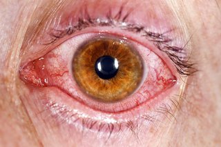 Viral conjunctivitis