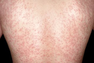 persons back covered with red rash on white skin