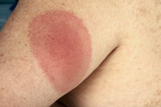 A round, red rash with a slightly darker centre, on the upper arm, caused by Lyme disease. Shown on white skin.