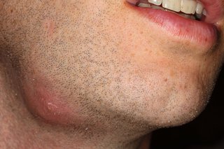 Red lump on white skin. The lump is on the jaw near the chin.