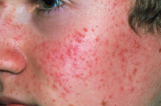 Cheek and side of face covered in small red spots on white skin.