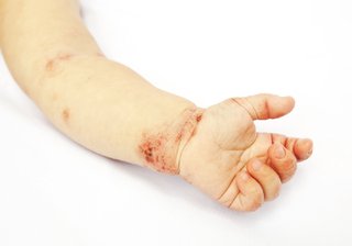 Image showing white baby's arm with patches of dry, cracked, red skin near wrist and in creases