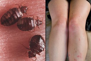 A side-by-side image of three bed bugs (left) and bed bug bites shown on the legs of someone with white skin (right). There are red raised bumps where the skin was bitten.