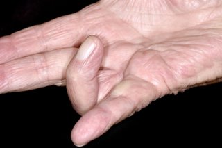 A hand with white skin held out flat with the ring finger bent in towards the palm.