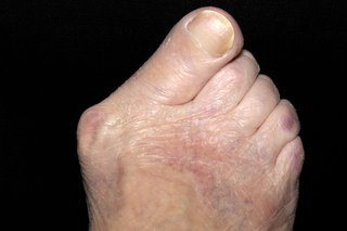 Right foot with lump at base of big toe and the big toe is pointing in towards the other toes