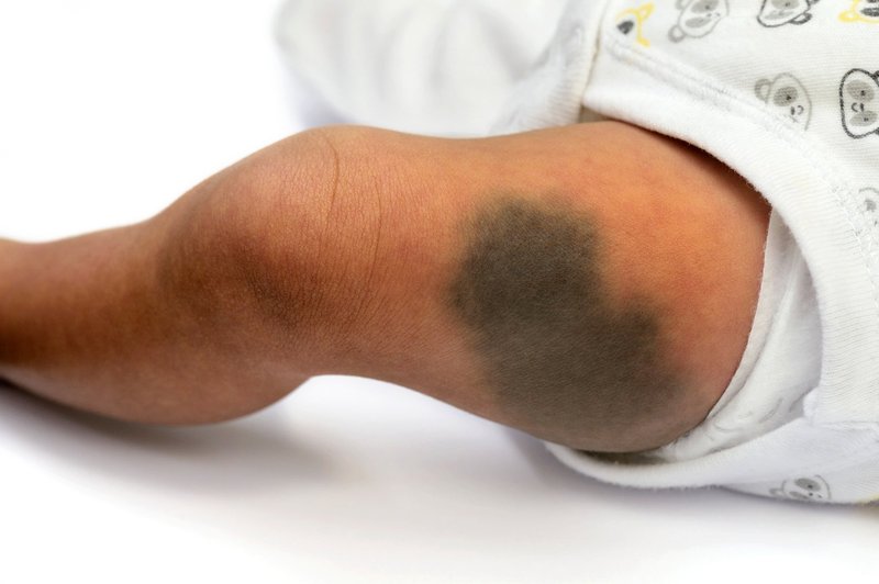 alt-text: Image showing blue spots on a baby&#x27;s leg, which can look blue-grey on the skin like a bruise