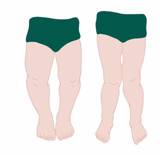 Two outlines of a child's legs. The one on the left shows knees staying apart as in bow legs. The one on the right shows knees together as in knock knees.