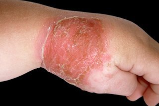 A red and golden crusty patch on the hand of a young child, shown on white skin.