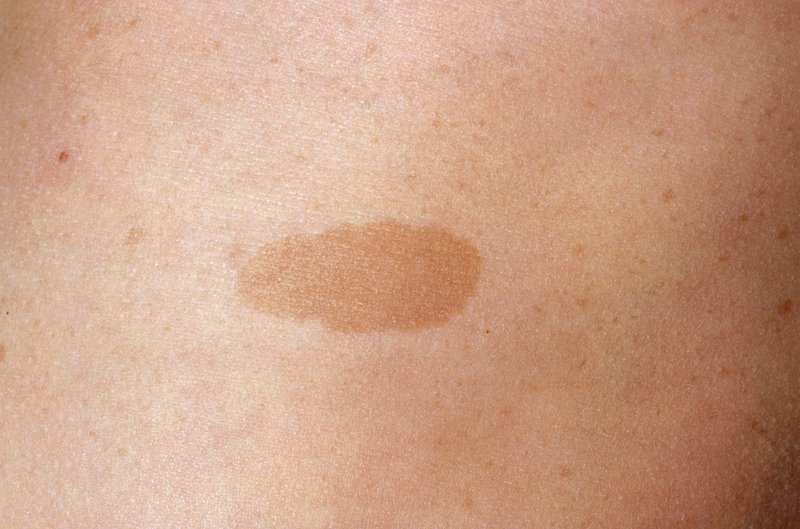 Image showing cafe-au-lait spot, which looks like a light or dark brown patch on skin