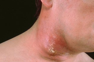 Close up of a neck with a cluster of boils that are leaking pus