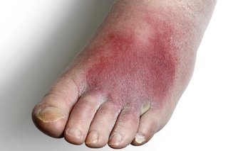 Foot with white skin. The top of the foot is red and swollen.