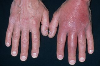 Hands with white skin. The fingers are red and swollen.