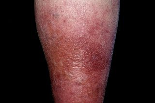 lower leg with red and swollen skin