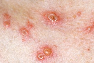 Chickenpox spots scab over