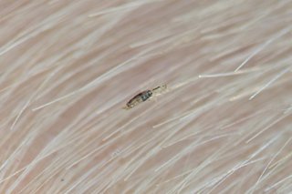 close up head lice