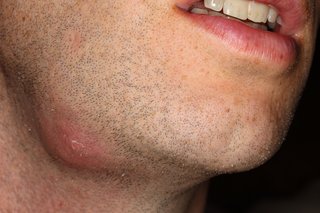An abscess on the the neck