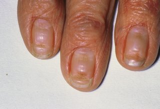 Three fingers with grooves in the finger nails