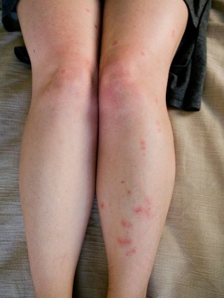 bedbug bites shown on the legs of someone with white skin. There are red raised bumps where the skin was bitten.