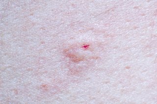 A bee sting shown on white skin. There is a red swollen mark where the skin was stung.