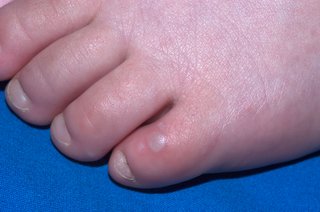 Blisters on a child's toe